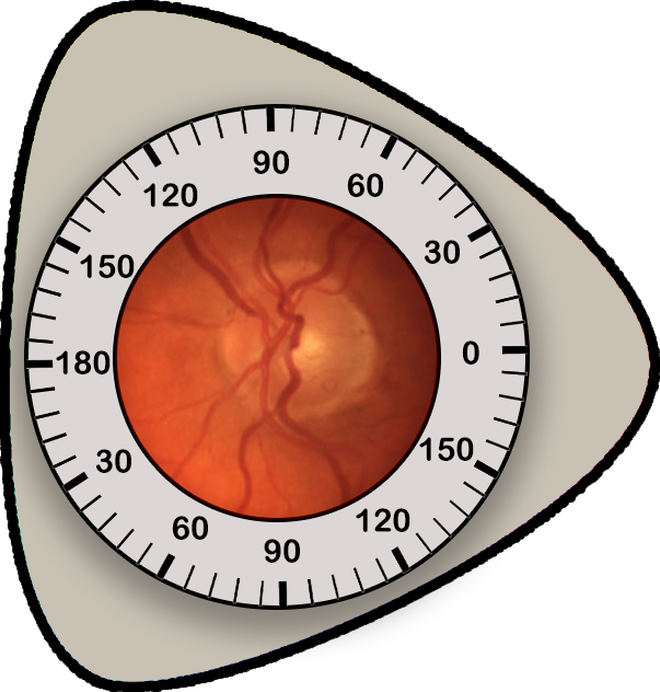 Eye Exam Data